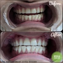Dental Restoration